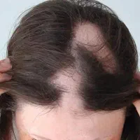 تخفیفات ویژه زیبایی و حجامت PRP