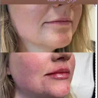 تخفیفات ژل بوتاکس مزو میکرو