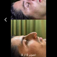 عمل بینی بلفارو ابدو لیپو