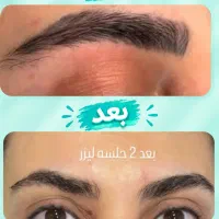 اولین مرکز تخصصی پاک کردن(ریموو)تتو ابرو،بدن مایا