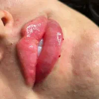 مدل ژل بوتاکس فقط هزینه مواد گرفته میشود سی 600