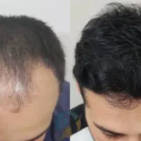 موهات دارن دسته جمعی میرن
