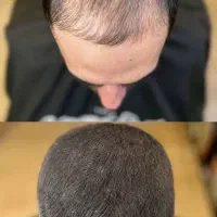 خداحافظی با طاسی و کم پشتی مو