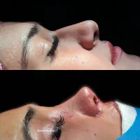 جراحی زیبایی بینی ۲۹/۹۰۰