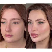 تخفیف ویژه اموزش وتزریق ژل و چربی صورت