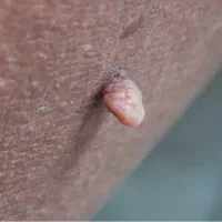 درمان قطعی زگیل و تبخال تناسلی به صورت ریشه ای
