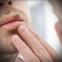 درمان hpv یا همون زگیل تناسلی