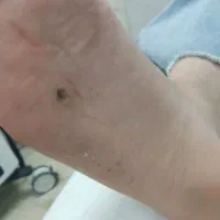 کلینیک درمان زگیل تناسلی ،زگیل صورت ومیخچه