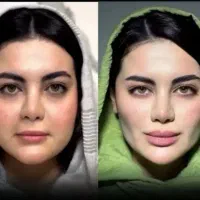 تزریق فیلربوتاکس لیفت شقیقه لیپوساکشن پزشک تبریز