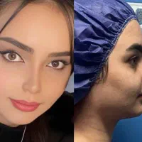 جراحی بینی بدون تامپون به روش پیزو،لیفت صورت