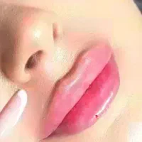 تزریق ژل و بوتاکس مزو
