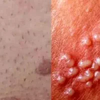 یک بار برای همیشه درمان ریشه ای زگیـ.ـل