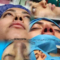 عمل زیبایی بینی در اهواز با تخفیف ویژه