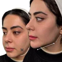 فیلر بینی کانتورینگ زیر چشم لیفت صورت بوتاکس مزوژل