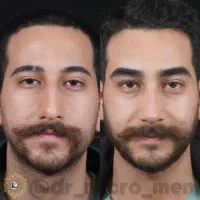 میکروبلیدینگ ابرو و اسکالپ سر و شیدینگ لب آقایان