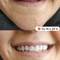 دندان مصنوعی دندانسازی