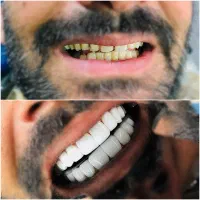کامپوزیت دندان تضمینی و درجه یک|خدمات آرایشگری و زیبایی|کرج, کرج نو|دیوار