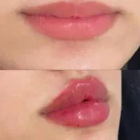 تخفیف بوتاکس وفیلر