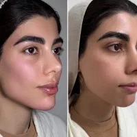 تزریق ژل بادی و فیلر بادی بیکینی باسن هیپ دیپ
