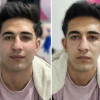 ژل -بوتاکس -فیلر -مزوتراپی ها -پرسینگ ها