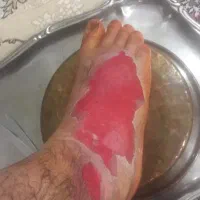 درمان زخم