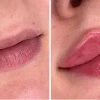 تخفیفات جشنواره ای،فیلر،آنزیم،بوتاکس