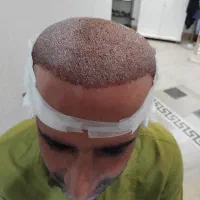 کاشت مو پرتراکم با تضمین کتبی نقد اقساط|خدمات آرایشگری و زیبایی|ساری, |دیوار