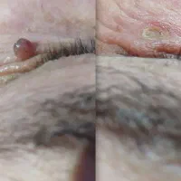 برداشت انواع خال‌بردای بانوان