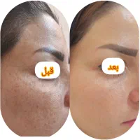 ریموو پاکسازی کک و مک با تکنولوژی نانوآراف در مطب