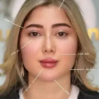 جشنواره تخصصی ژل فیلر هایفو بایوفیلر در کلینیک