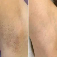 رفع دائم موهای زائد