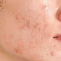 کرم ضد جوش و آکنه و کنترل چربی