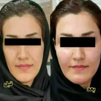 تپلی صورت( صددرصدتضمینی)