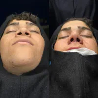 رینو پلاستی با تکنیک انحصاری قیمت انفجاری