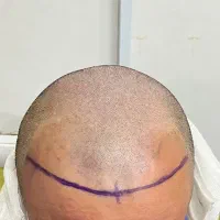 کاشت مو