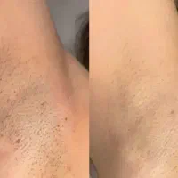 مرکز لیزرموهای زائد،میکروندلینگ،مزوتراپی،مزووایت