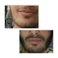 بمب ریش و مو