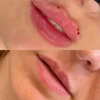 تزریق ژل،بوتاکس آنزیم آموزش مزوتراپی مزونیدلینگ