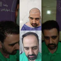کاشت مو، ابرو کاشت تخصصی حرفه ای ریش شروع۱۵ میلیون