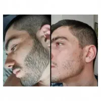 قبل از کاشت ریش اینو ببین