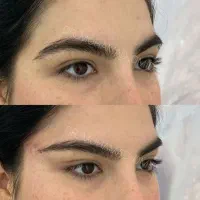 لیفت نخ دوسوزنه لیفت شقیقه و ابرو و صورت