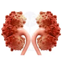 سنگ کلیه و سنگ صفرا