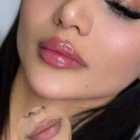 خدمات و اموزش فیلر لب و کل صورت،بوتاکس