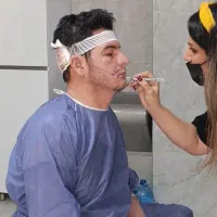 کاشت ریش طبیعی ،با دستگاه جدید کاشت ریش