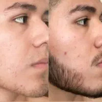 چرا ریشت یکدست رشت نمیکنه برسی تخصصی کم پشتی،و خط
