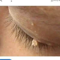 حذف منگوله گوشتی ۳۵۰