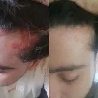 بهبود کامل پسوریازیس