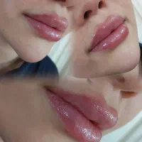 تزریق ژل لب و بوتاکس