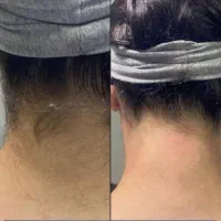 تخفیف (۵۰ درصدی)۳روزه لیزرموهای زائدفول فقط(399