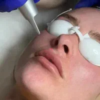 (خطر) لیزر موهای زائد، موهای صورتت رو ضخیم میکنه
